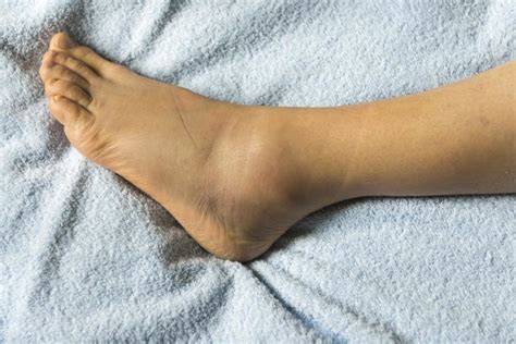 cum se pot vindeca varicele la nivelul picioarelor?